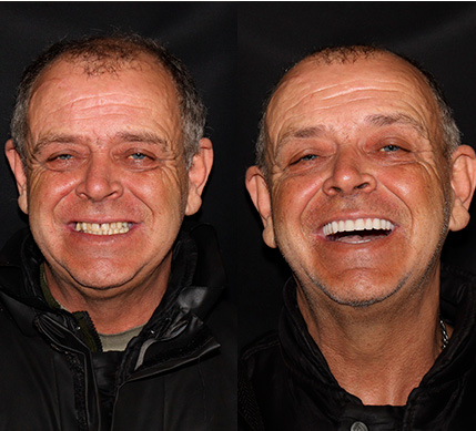 3antesedepois